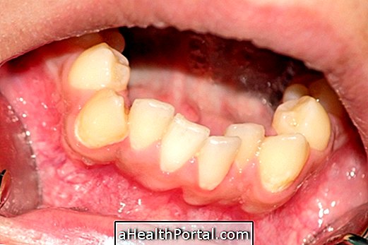 What is the Crossbite and How to Treat
