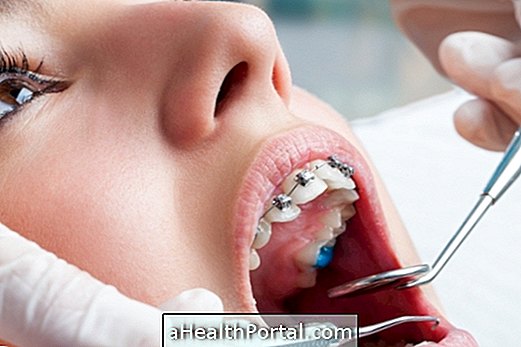 Arten der Zahnfehlstellung und Behandlung