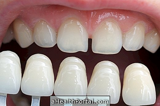 Hambaravi kontaktläätsed: mida see on ja millal see panna