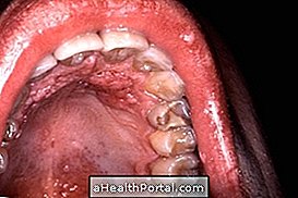 Symptome und Behandlung von HPV im Mund