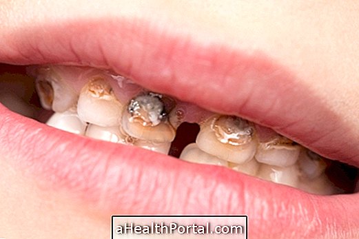 Kuidas ravida hambaemalade hüpoplaasiat