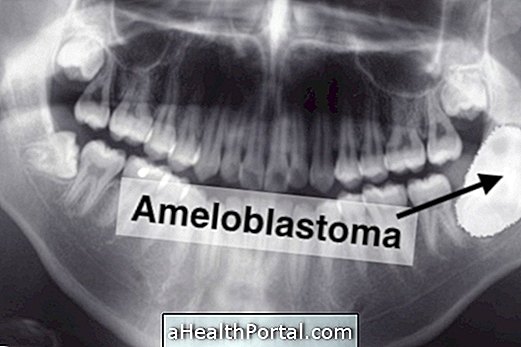 Što Ameloblastoma i kako postupati