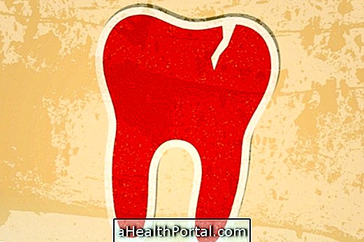 Was tun im Falle eines Zahnbruchs?