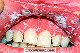 Hvordan man identificerer og behandler oral candidiasis
