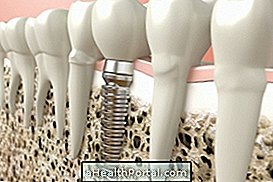 When to put a dental implant and how much does it cost