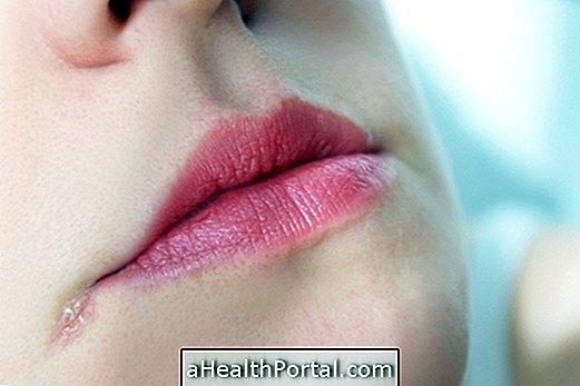 Sužinokite, kokios yra priežastys ir kaip gydyti žaizdą burnos kampe