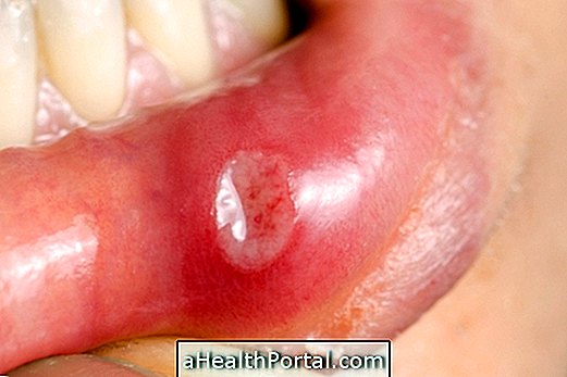 Hvad forårsager laven planus i munden og hvordan man behandler det