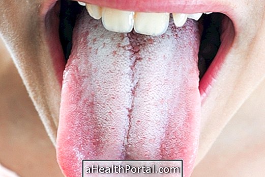 Weiße Zunge: Ursachen und was zu tun ist