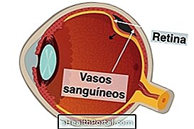 Kako je zdravljenje retinopatije pred prezhrompto