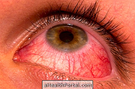 อะไรคือไวรัสตาแดงและวิธีการรักษา