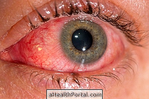 โรคตาแดงและตาคือวิธีการรักษา