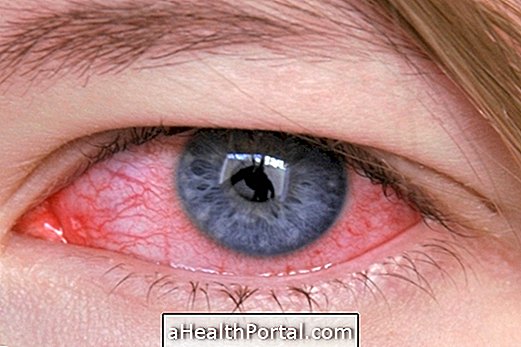 Що таке туберкульоз з очей і як лікувати це