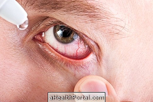 Symptome einer allergischen Konjunktivitis und Umgang mit Augentropfen