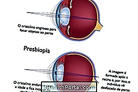 Symptoms of presbyopia