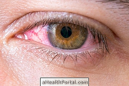 What is xerophthalmia and how to identify
