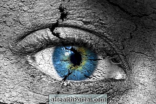 Trockenes Auge-Syndrom identifizieren und behandeln