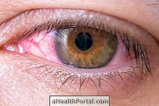 How is the treatment for conjunctivitis done?