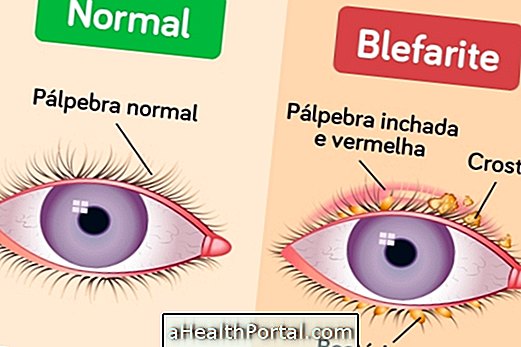 Blefaritis: Hvad det er, symptomer og behandling