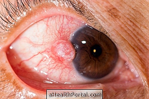 Comment traiter la sclérite pour éviter la cataracte