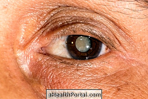 Treatment for Cataract: surgery or eye drops