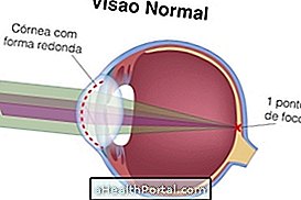 Hvad er astigmatisme og hvordan man behandler det
