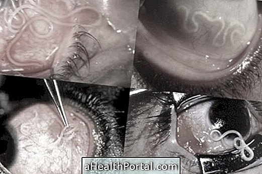 Vigtigste symptomer og behandling for øjenkrop