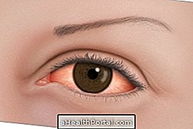 Ocular Rosacea