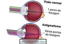 Symptomer på astigmatisme og hvordan å behandle