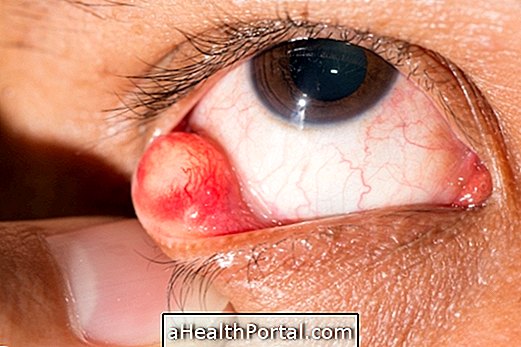 What is chalazion in the eye, why it happens and how to treat