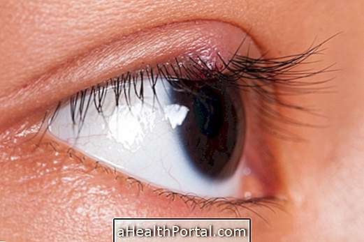How to treat stye at home