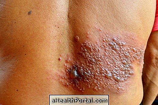 Home Herpes Zoster Behandling