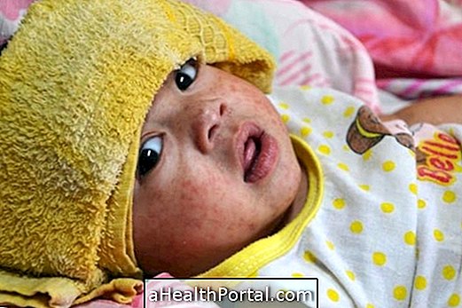 Home Remedies lindre Measles Symptomer