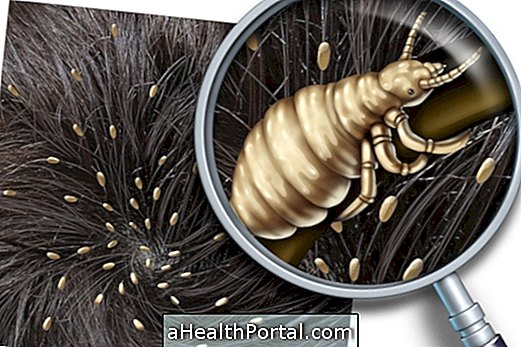 4 Home Remedies for Head Lice