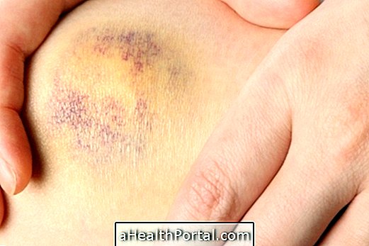Home Remedies to Take Purple Skin Marks