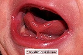 איך אפשר לדעת אם התינוק שלך יש טרף הלשון