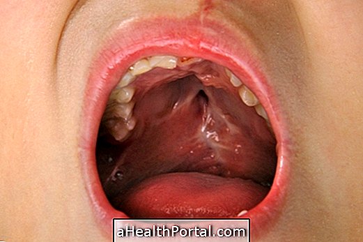 口蓋裂とハンセン病 - 原因と治療法
