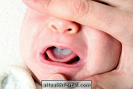 When surgery to treat tongue prey is indicated