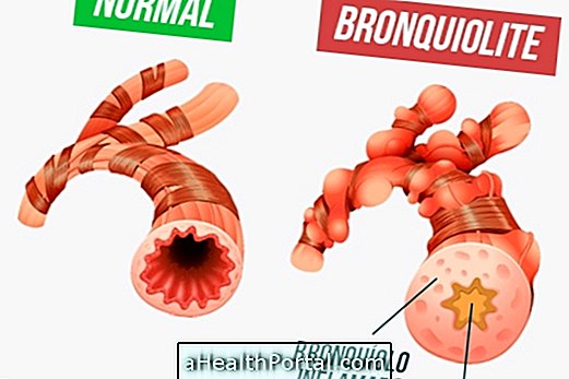 Kako prepoznati i spriječiti bronhiolitis