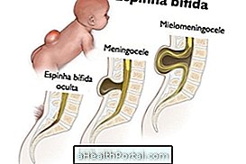 baba egészség - Spina bifida