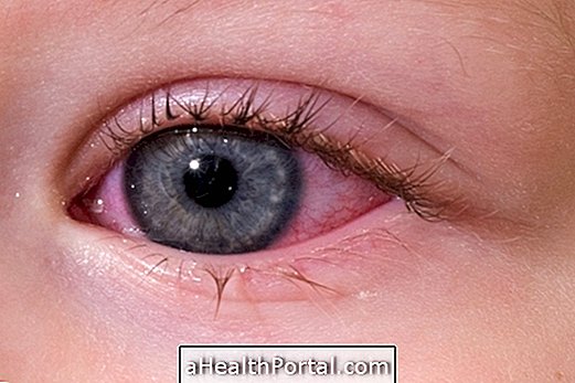How to Identify and Treat Conjunctivitis in a Baby