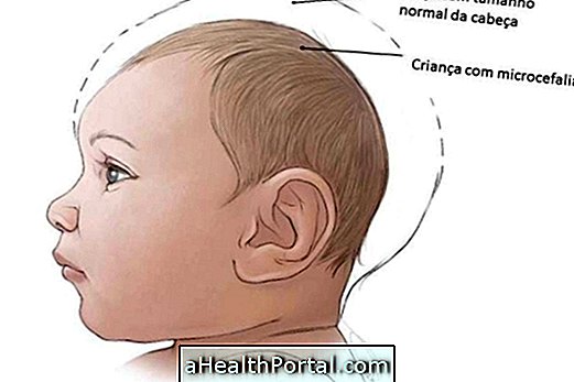 Suprasti, kas yra Microcephaly ir kokios pasekmės yra kūdikiui