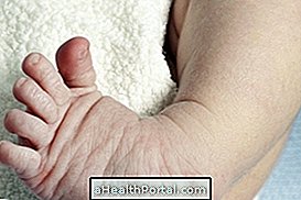 Congenital Tortoid Foot