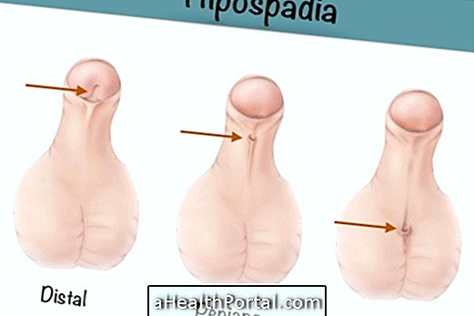 Hypospadia - urin, der kommer ud under barnets penis