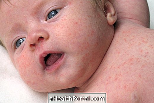 Allergy in baby's skin: symptoms and what to do