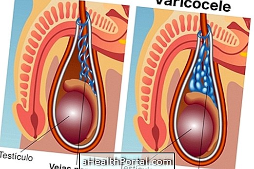 Što je varikokela i kako je operacija učinjena