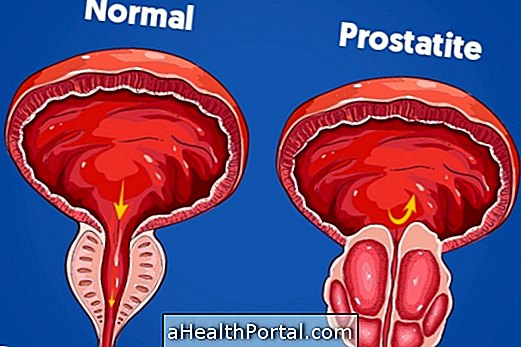 Apakah itu dan apa gejala prostatitis?