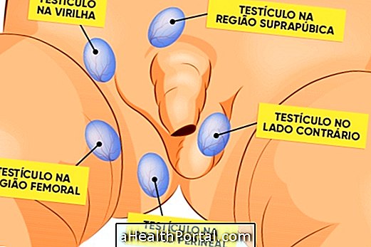 Cryptorchidism - When the testicle did not go down
