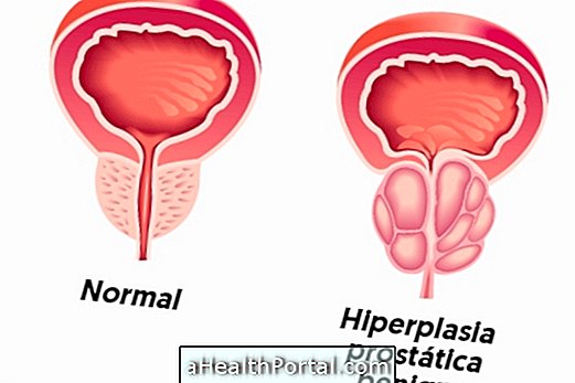 Hvad er godartet prostatisk hyperplasi og hvordan man behandler det