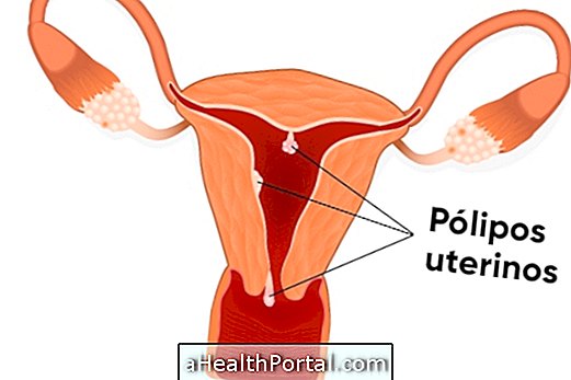 Symptoms of uterine polyp