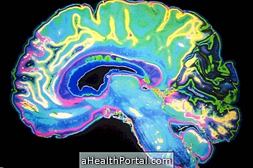 10 signes précurseurs de la maladie d'Alzheimer